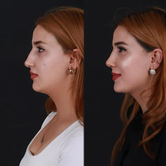 Rinoplasti 05