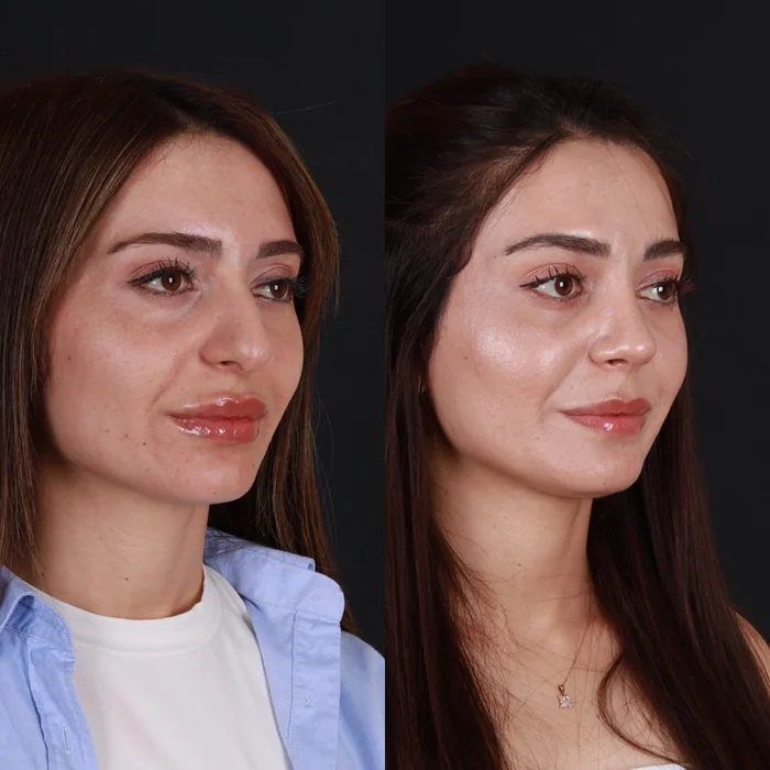 Rinoplasti 11