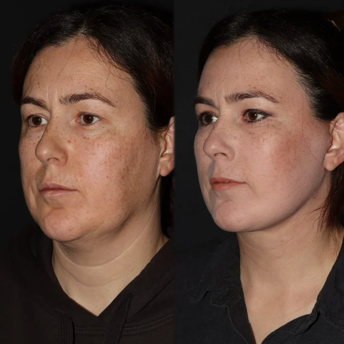 Yüz germe 02