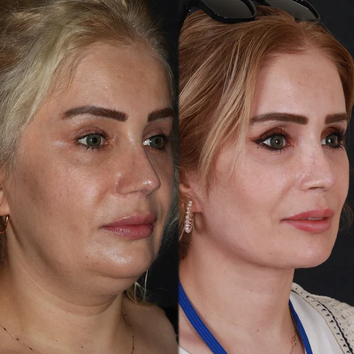 Yüz germe 03