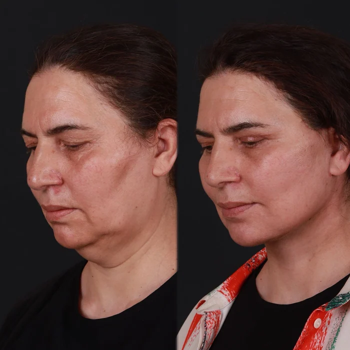 Yüz germe 04
