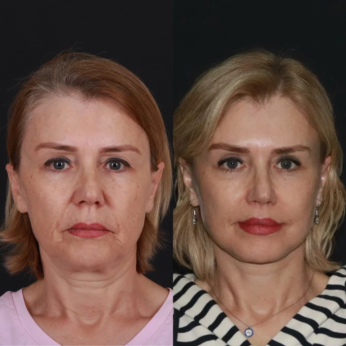 Yüz germe 06