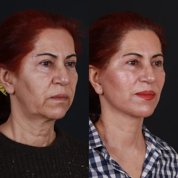 Yüz germe 07