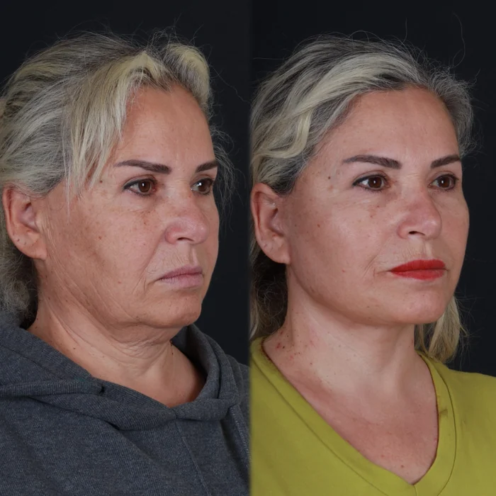 Yüz germe 08