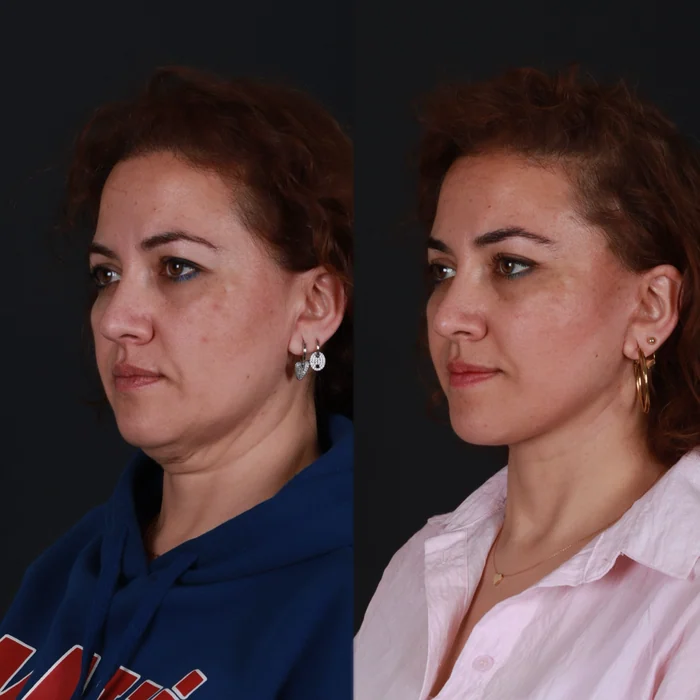 Yüz germe 09