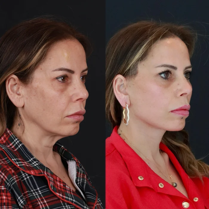 Yüz germe 10